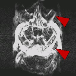 MRI Artifacts - Artifact by Patient Movement - MR-TIP.com