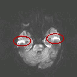 MRI Artifacts - Susceptibility Artifact - MR-TIP.com