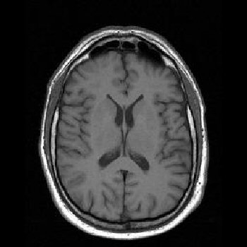 mri brain scan. MR-TIP - MRI Images: Brain MRI