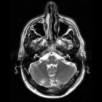 MRI Images - Brain MRI Transversal T2 001 - MR-TIP.com