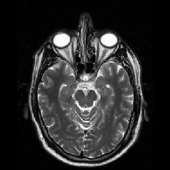 brain mri images