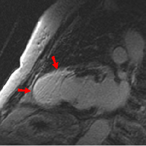 Cardiac Infarct