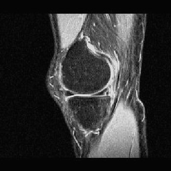 Mri Knee