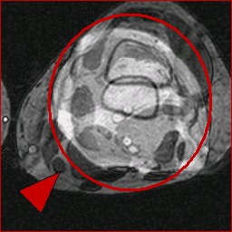 MRI Artifacts - Aliasing Artifact - MR-TIP.com