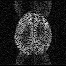 MRI Artifacts - Eddy Current Artifact - MR-TIP.com