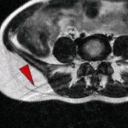 MRI Artifacts - ghosting artifact - MR-TIP.com