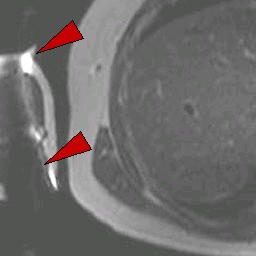 artifact mri metallic susceptibility metal tip mr caused study case artifacts object